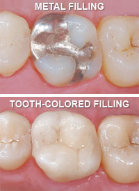 Read more about the article Fillings