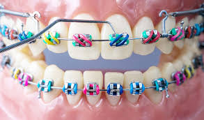Read more about the article Orthodontics